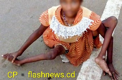 Ituri : des cas suspects de rougeole et de paralysie flasque aiguë détectés par l’antenne PEV d’Aru